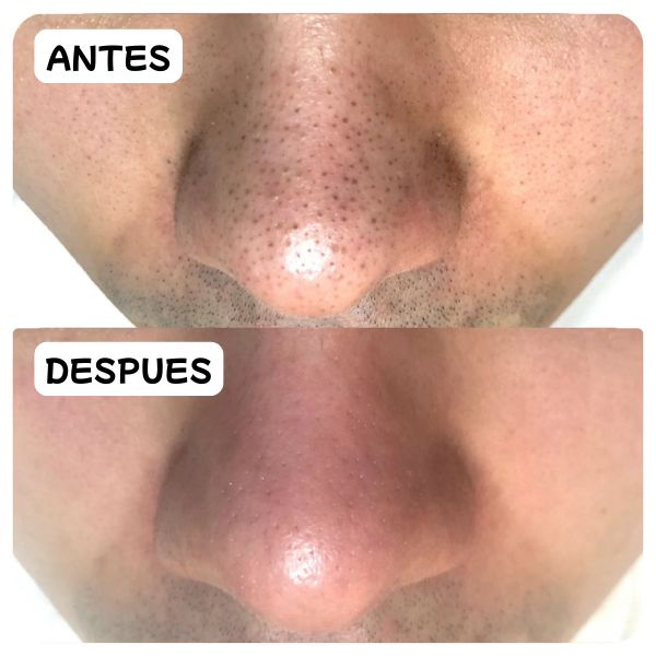 Lanbena: Tratamiento Intensivo contra Puntos Negros