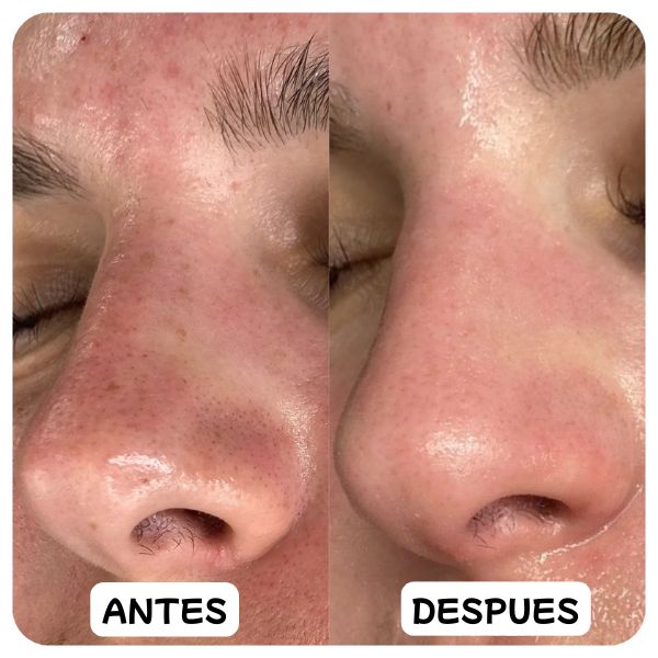 Lanbena: Tratamiento Intensivo contra Puntos Negros