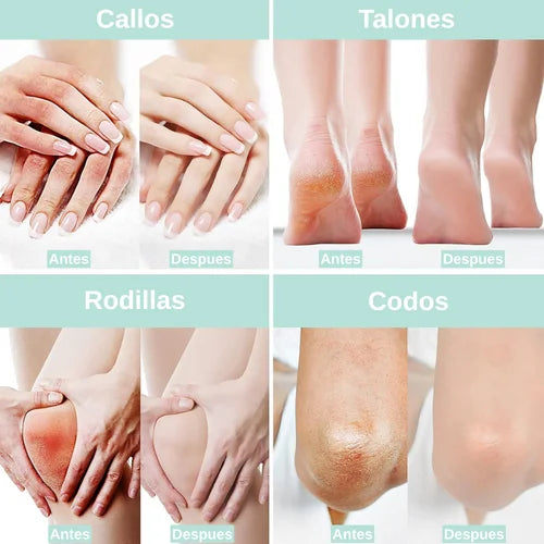 Crema de Urea al 40% para piel seca, dura y agrietada